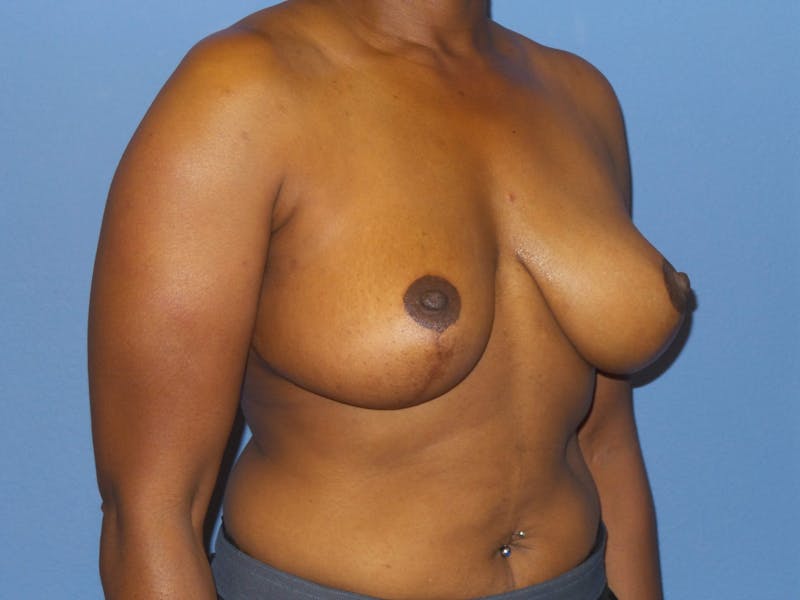 Breast Reduction Before & After Gallery - Patient 254654 - Image 6