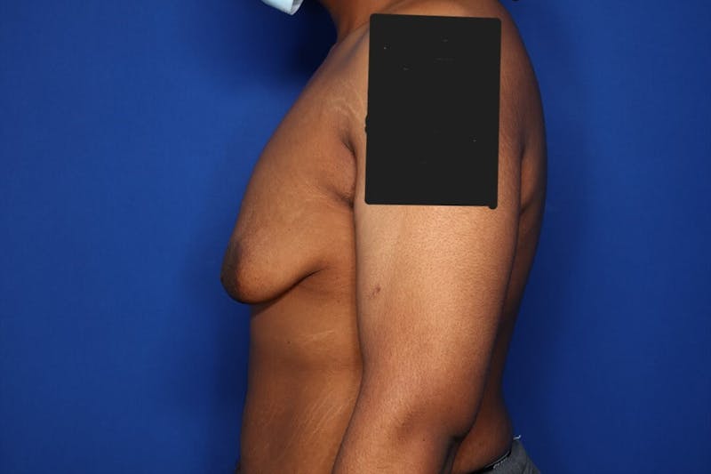Gynecomastia (Male Breast Reduction) Before & After Gallery - Patient 207748 - Image 5