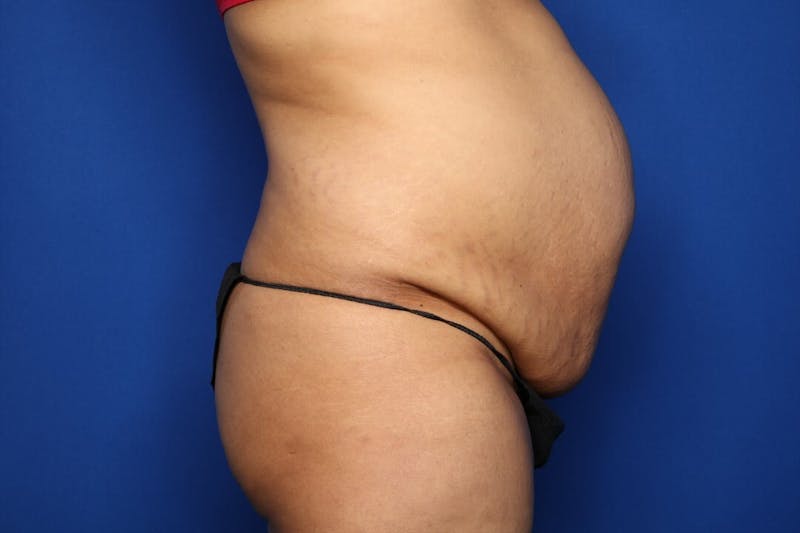 Tummy Tuck Before & After Gallery - Patient 719302 - Image 3