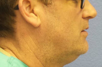 Kybella® Before & After Gallery - Patient 143491 - Image 1