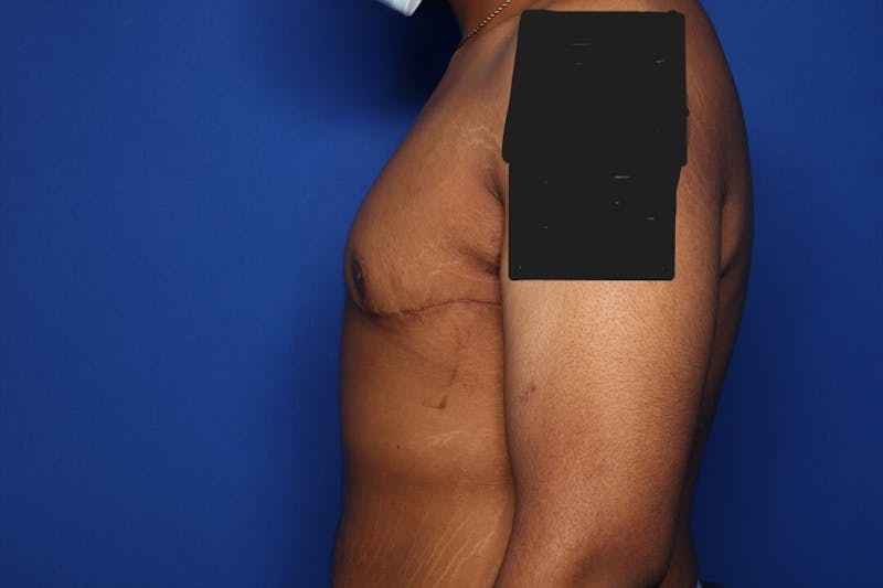 Gynecomastia (Male Breast Reduction) Before & After Gallery - Patient 207748 - Image 6