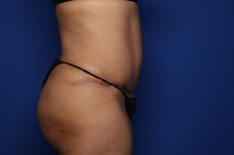 Tummy Tuck Before & After Gallery - Patient 719302 - Image 4