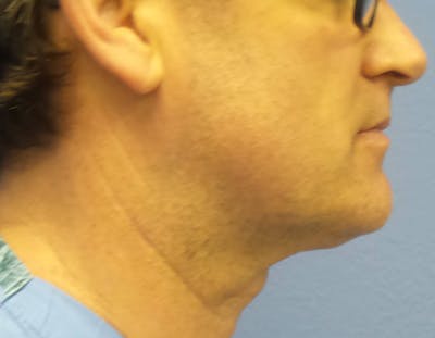 Kybella® Before & After Gallery - Patient 143491 - Image 2