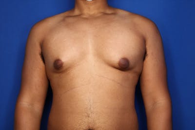 Gynecomastia (Male Breast Reduction) Before & After Gallery - Patient 168979 - Image 1
