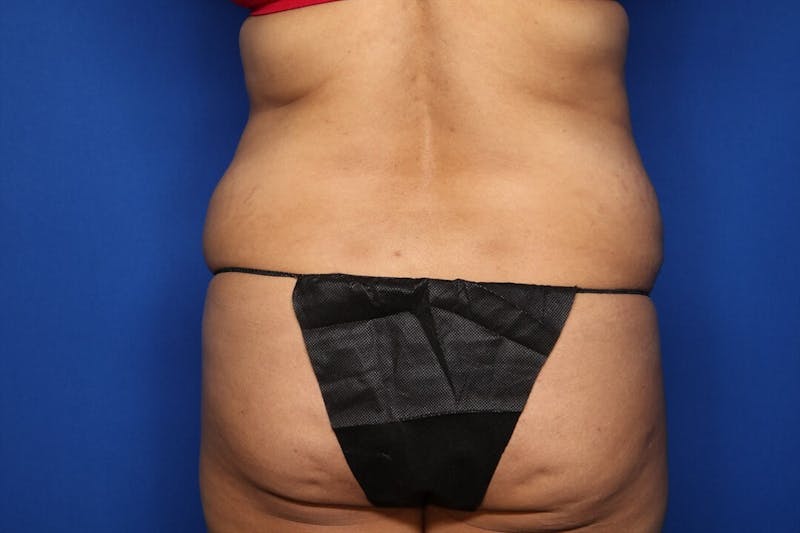 Tummy Tuck Before & After Gallery - Patient 719302 - Image 5