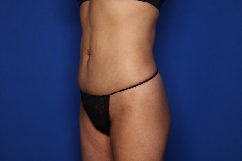 BodyTite™ Before & After Gallery - Patient 931597 - Image 6