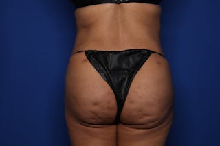 Tummy Tuck Before & After Gallery - Patient 719302 - Image 6