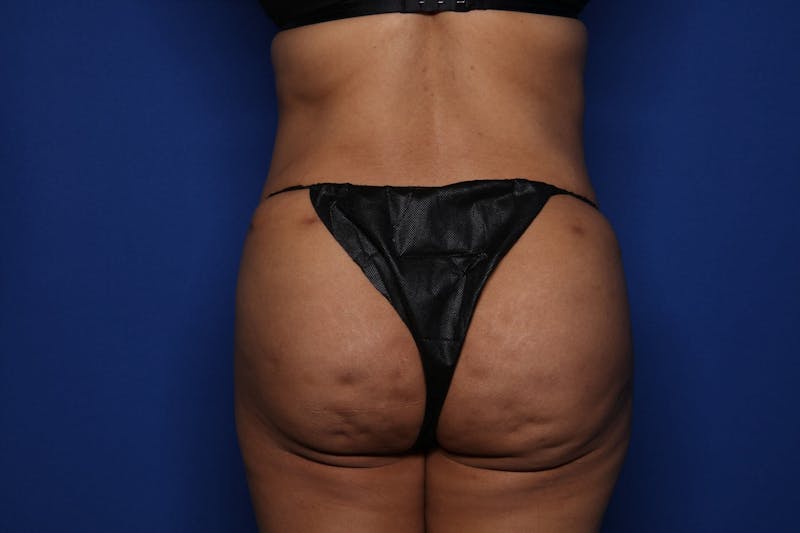 Tummy Tuck Before & After Gallery - Patient 719302 - Image 6