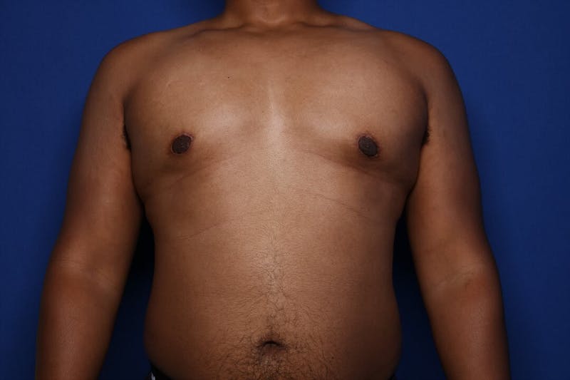 Gynecomastia (Male Breast Reduction) Before & After Gallery - Patient 168979 - Image 2