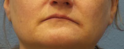 Restylane® Before & After Gallery - Patient 145185 - Image 1