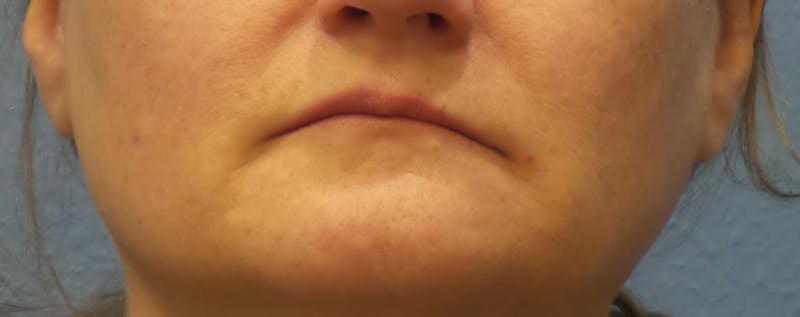 Restylane® Before & After Gallery - Patient 145185 - Image 1