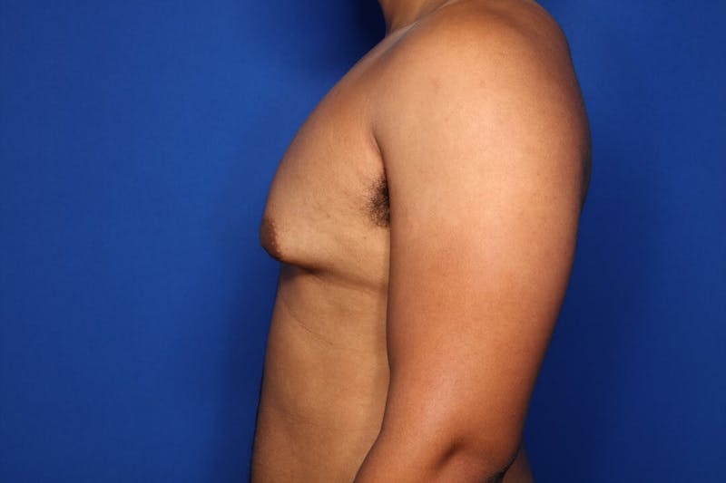 Gynecomastia (Male Breast Reduction) Before & After Gallery - Patient 168979 - Image 3
