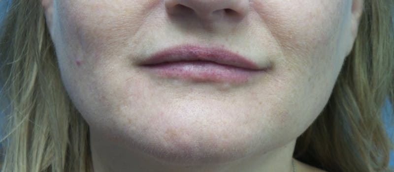 Restylane® Before & After Gallery - Patient 145185 - Image 2
