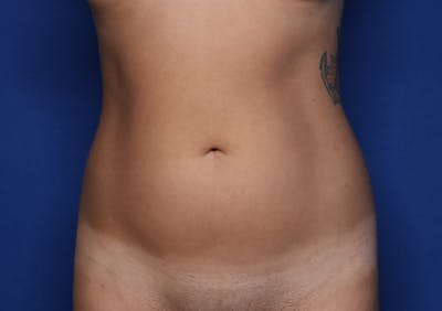 Liposuction Before & After Gallery - Patient 689767 - Image 1