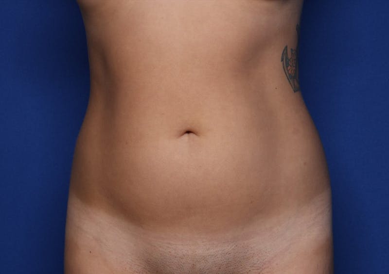 Liposuction Before & After Gallery - Patient 689767 - Image 1