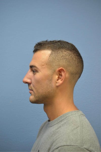 Juvéderm® Before & After Gallery - Patient 818028 - Image 2