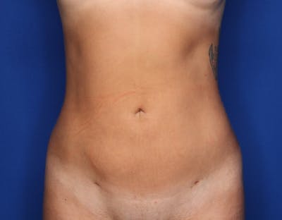 Liposuction Before & After Gallery - Patient 689767 - Image 2