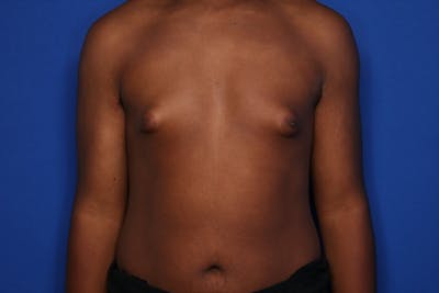 Gynecomastia (Male Breast Reduction) Before & After Gallery - Patient 604288 - Image 1