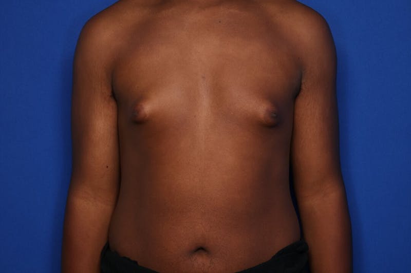 Gynecomastia (Male Breast Reduction) Before & After Gallery - Patient 604288 - Image 1