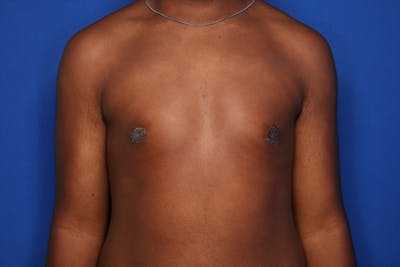 Gynecomastia (Male Breast Reduction) Before & After Gallery - Patient 604288 - Image 2