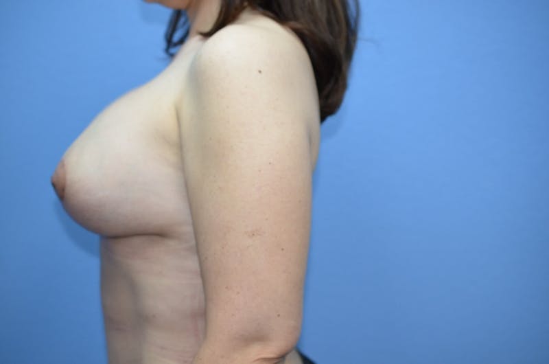 Breast Revision Before & After Gallery - Patient 225709 - Image 4
