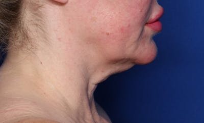 FaceTite Before and After Before & After Gallery - Patient 144838 - Image 1