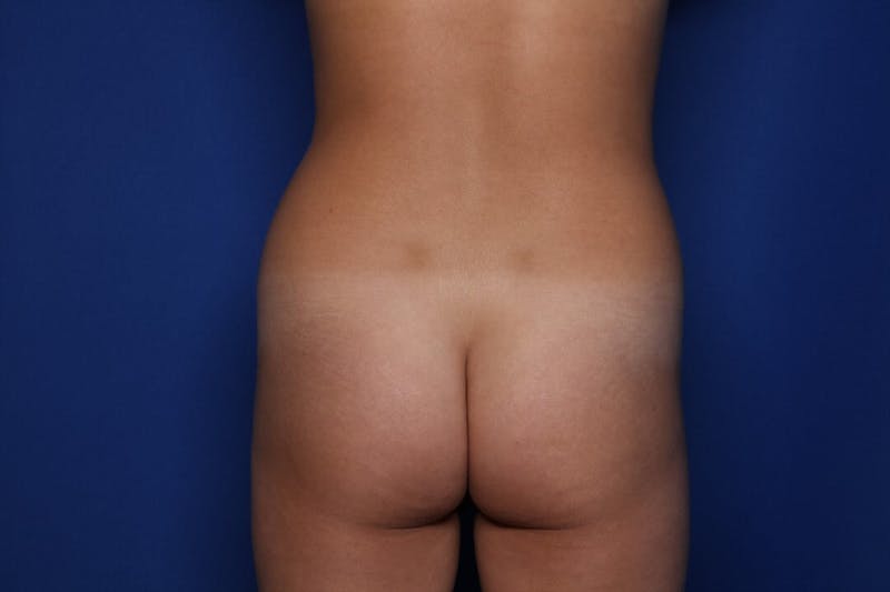Liposuction Before & After Gallery - Patient 689767 - Image 5