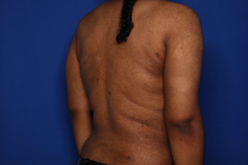 BodyTite™ Before & After Gallery - Patient 356888 - Image 4