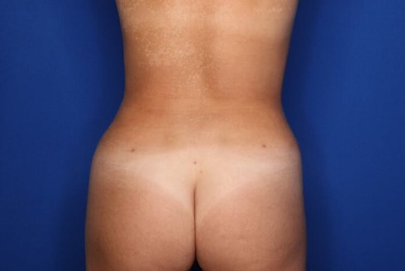 Liposuction Before & After Gallery - Patient 689767 - Image 6