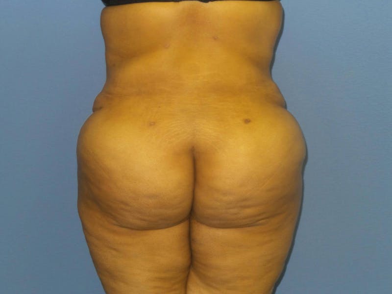 Brazilian Butt Lift Before & After Gallery - Patient 666456 - Image 4