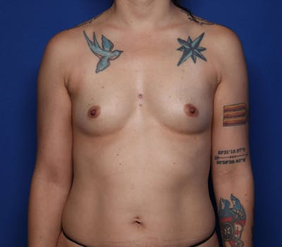 Breast Augmentation Before & After Gallery - Patient 149702 - Image 1