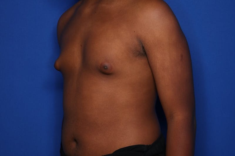 Gynecomastia (Male Breast Reduction) Before & After Gallery - Patient 604288 - Image 5