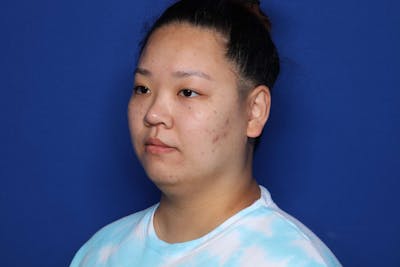 FaceTite Before and After Before & After Gallery - Patient 278531 - Image 1