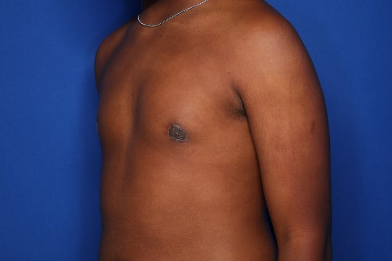 Gynecomastia (Male Breast Reduction) Before & After Gallery - Patient 604288 - Image 6