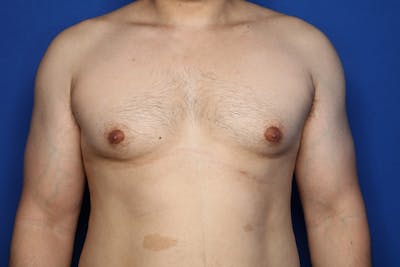 Gynecomastia (Male Breast Reduction) Before & After Gallery - Patient 272319 - Image 1