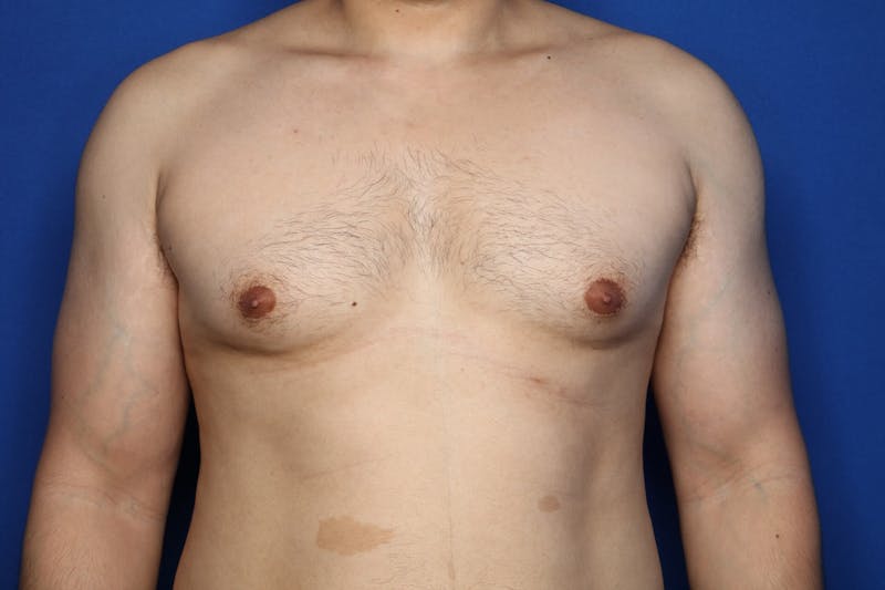 Gynecomastia (Male Breast Reduction) Before & After Gallery - Patient 272319 - Image 1