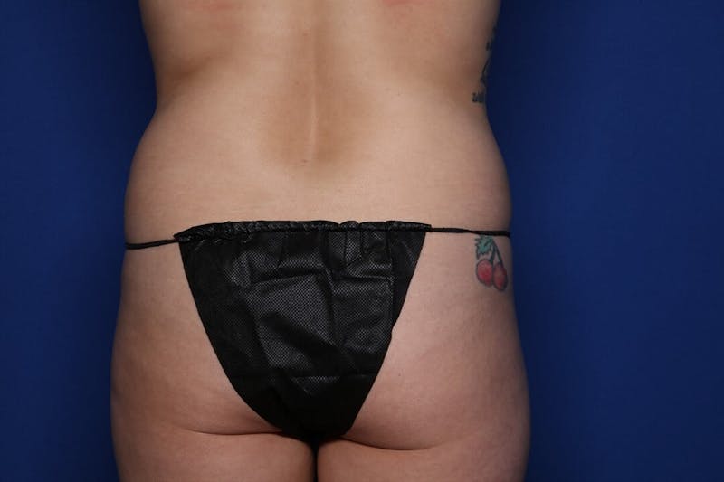 Tummy Tuck Before & After Gallery - Patient 345030 - Image 11