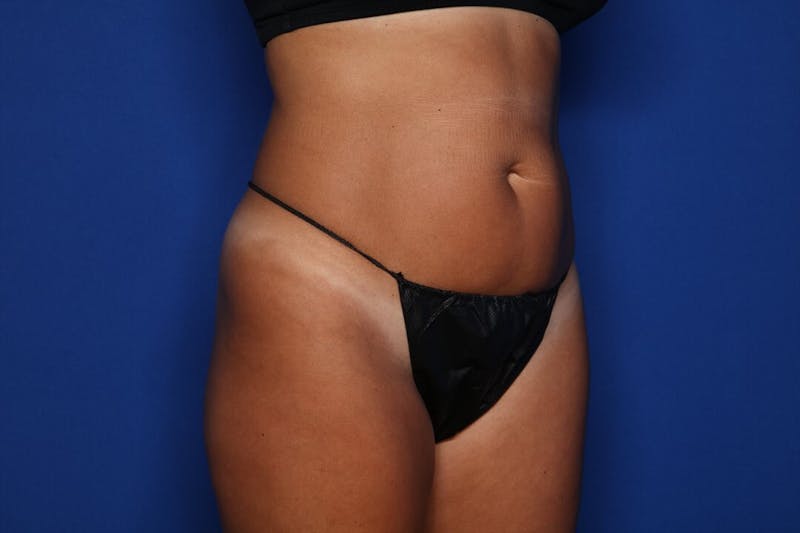 BodyTite™ Before and After Before & After Gallery - Patient 705705 - Image 3