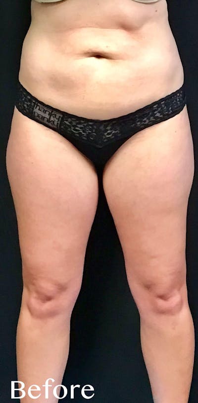 CoolSculpting Before & After Gallery - Patient 385234 - Image 1