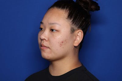 FaceTite Before and After Before & After Gallery - Patient 278531 - Image 2