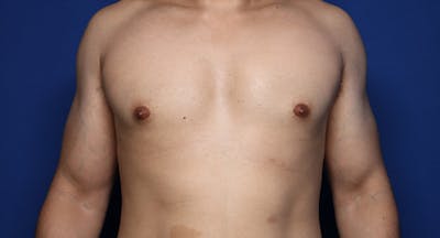 Gynecomastia (Male Breast Reduction) Before & After Gallery - Patient 272319 - Image 2