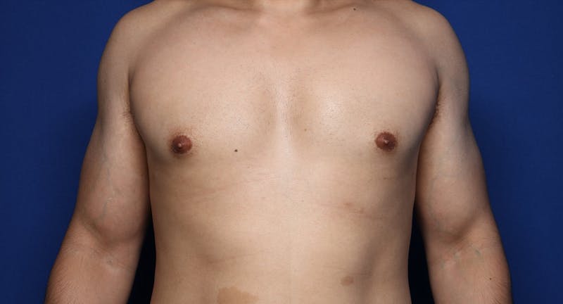 Gynecomastia (Male Breast Reduction) Before & After Gallery - Patient 272319 - Image 2