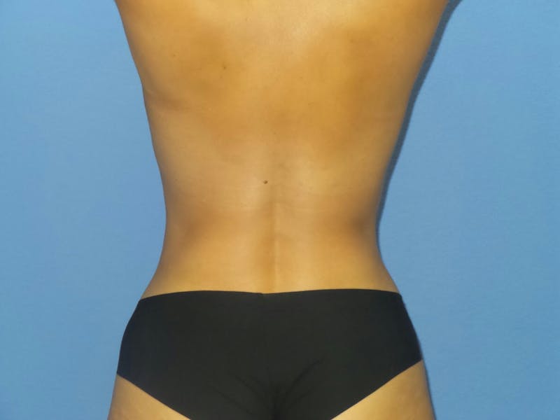 Liposuction Before & After Gallery - Patient 768707 - Image 4