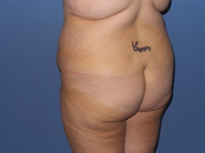 Brazilian Butt Lift Before & After Gallery - Patient 209799 - Image 1