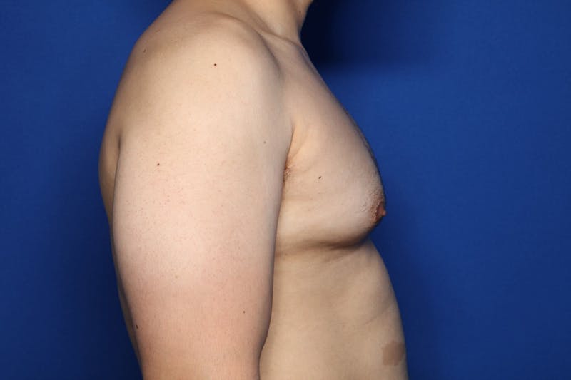 Gynecomastia (Male Breast Reduction) Before & After Gallery - Patient 272319 - Image 3