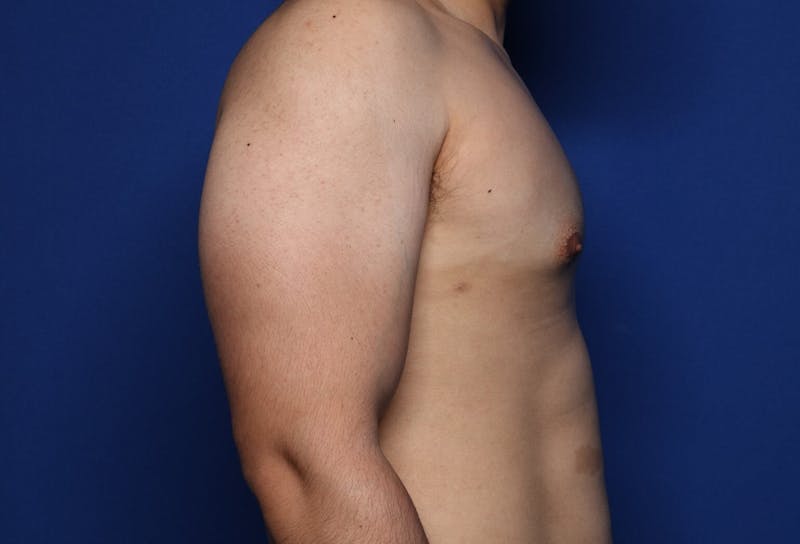 Gynecomastia (Male Breast Reduction) Before & After Gallery - Patient 272319 - Image 4