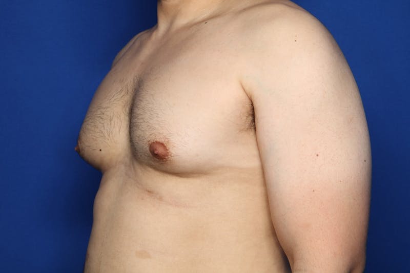 Gynecomastia (Male Breast Reduction) Before & After Gallery - Patient 272319 - Image 5