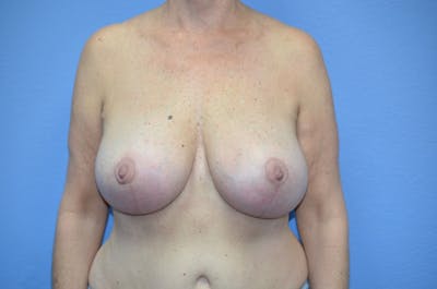 Breast Revision Before & After Gallery - Patient 155268 - Image 2