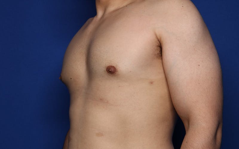 Gynecomastia (Male Breast Reduction) Before & After Gallery - Patient 272319 - Image 6