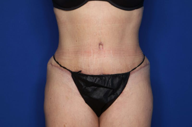 Tummy Tuck Before & After Gallery - Patient 707789 - Image 2